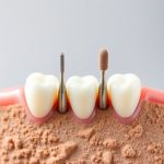 Dental Burs: Unlocking Real-World Learning Through Case Studies