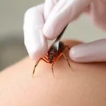 Pyrethrin: Understanding the Active Ingredient in Lice Treatment Products