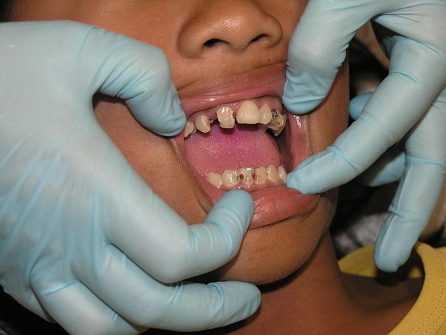 dental burs