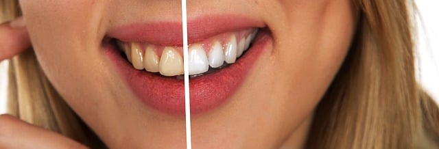 dental burs