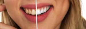 dental-burs-640x480-36160200.jpeg