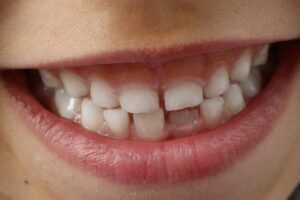 dental-burs-640x480-47630129.jpeg